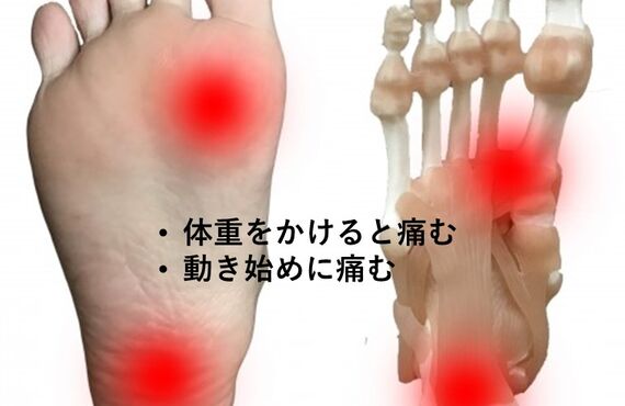 足底筋膜炎について